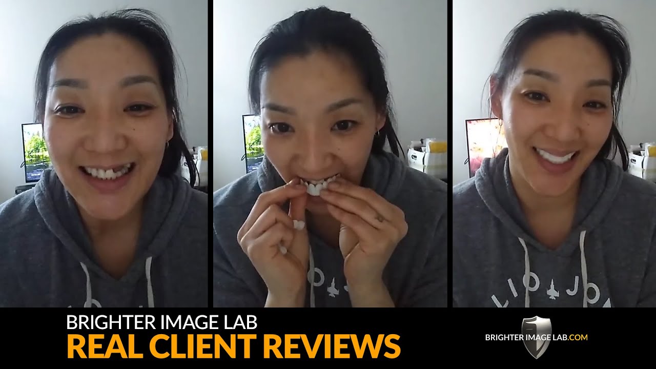 Real Client Smile Makeovers: Brighter Image Lab Dental Veneer Reviews – No Cosmetic Dentist Needed!