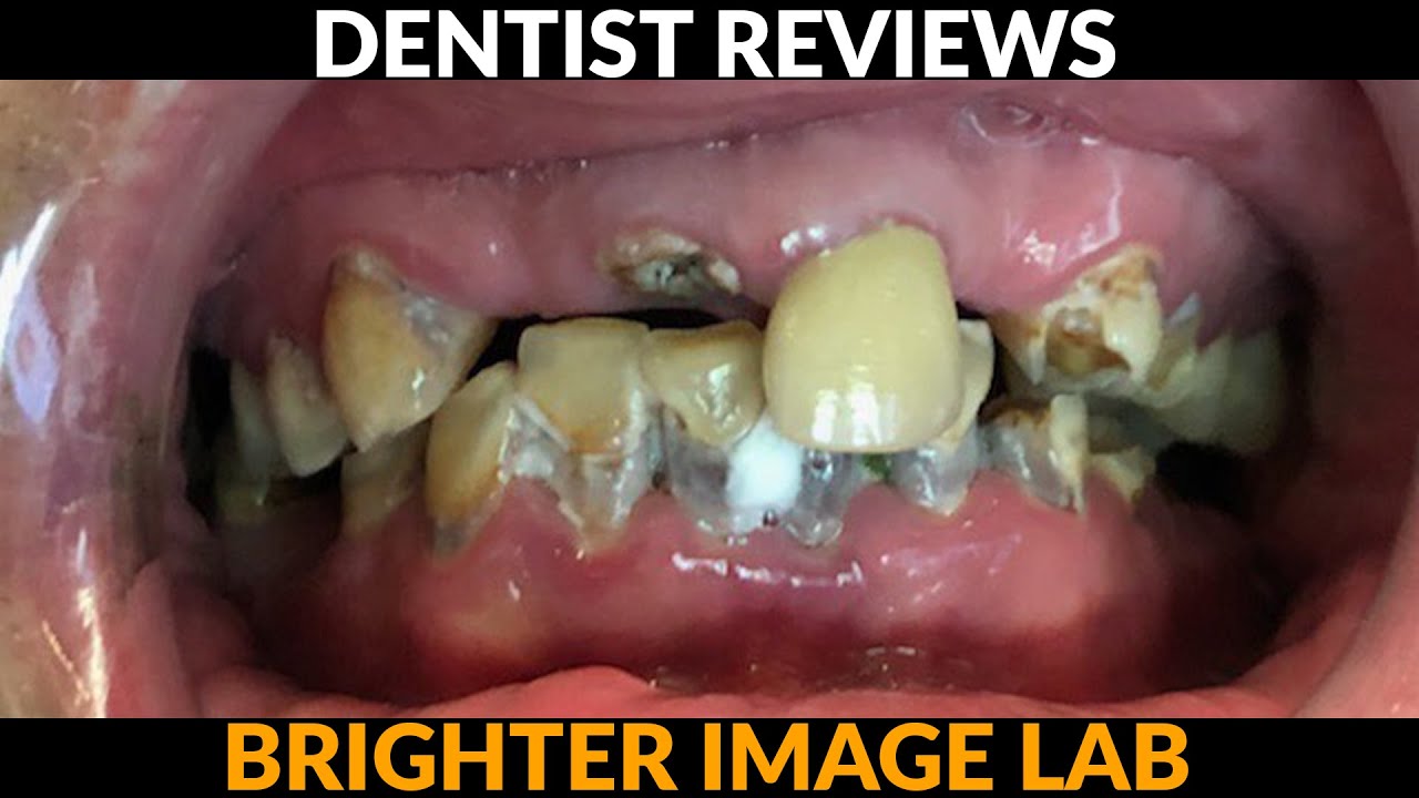 Top Cosmetic Dentist Helps w/ Smile Makeover – Dentist Reviews Dental Veneers by Brighter Image Lab!